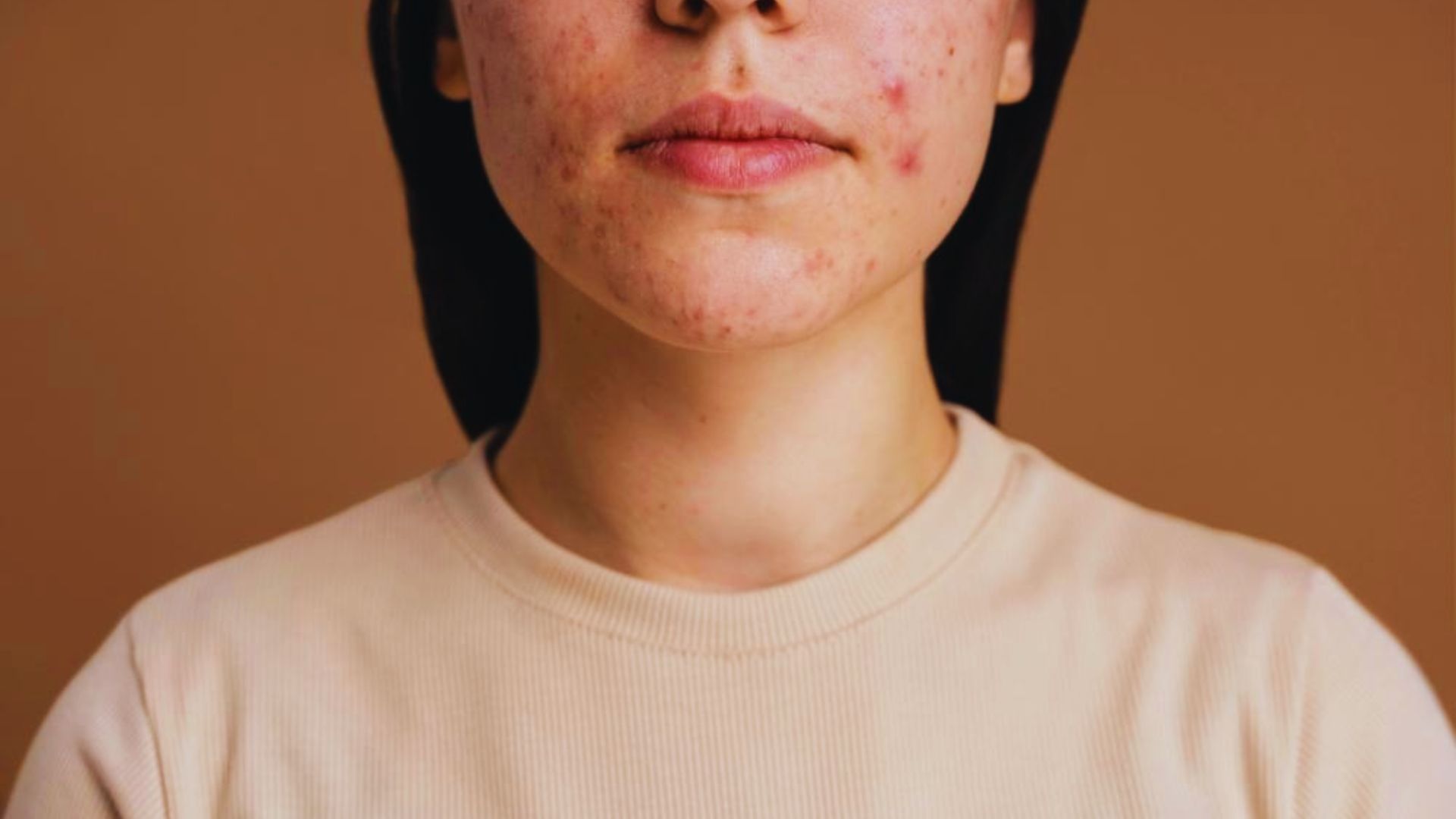A woman with acne on her face, highlighting the effects of Adapalene purging treatment.