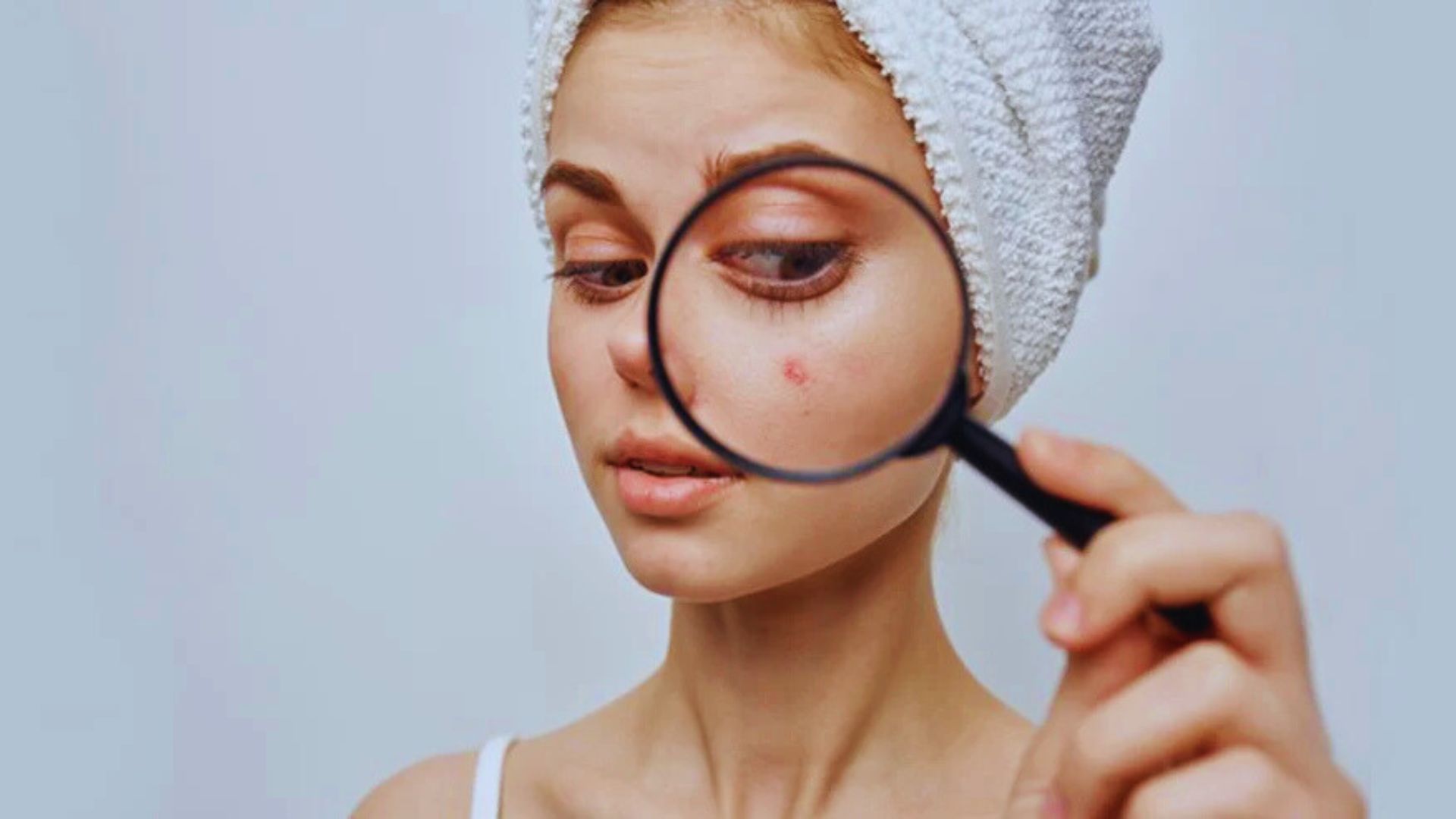 A woman with visible acne on her face, illustrating the differences between fungal and bacterial acne.