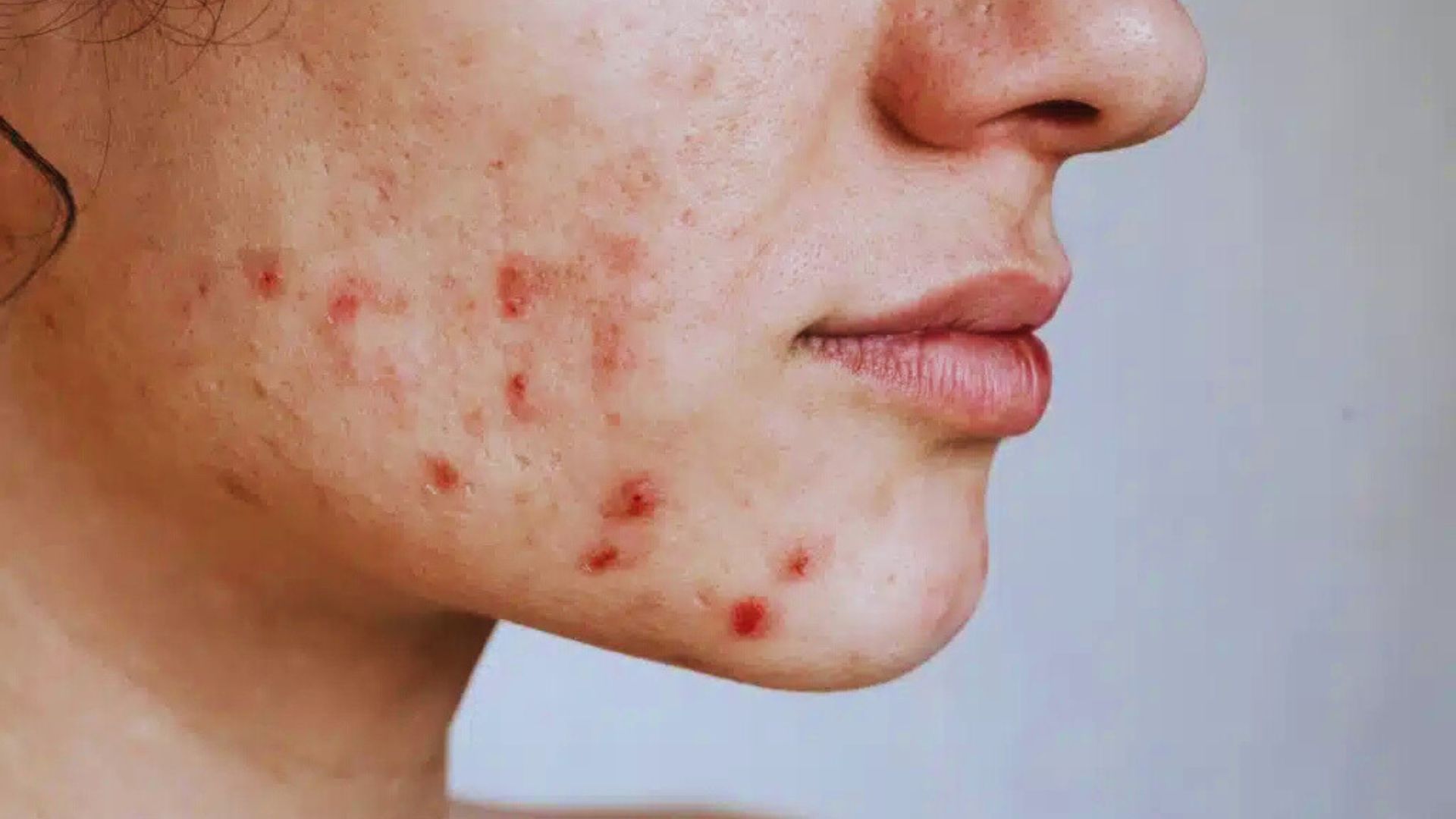A woman with acne prominently displayed on her jawline, highlighting her skin condition.