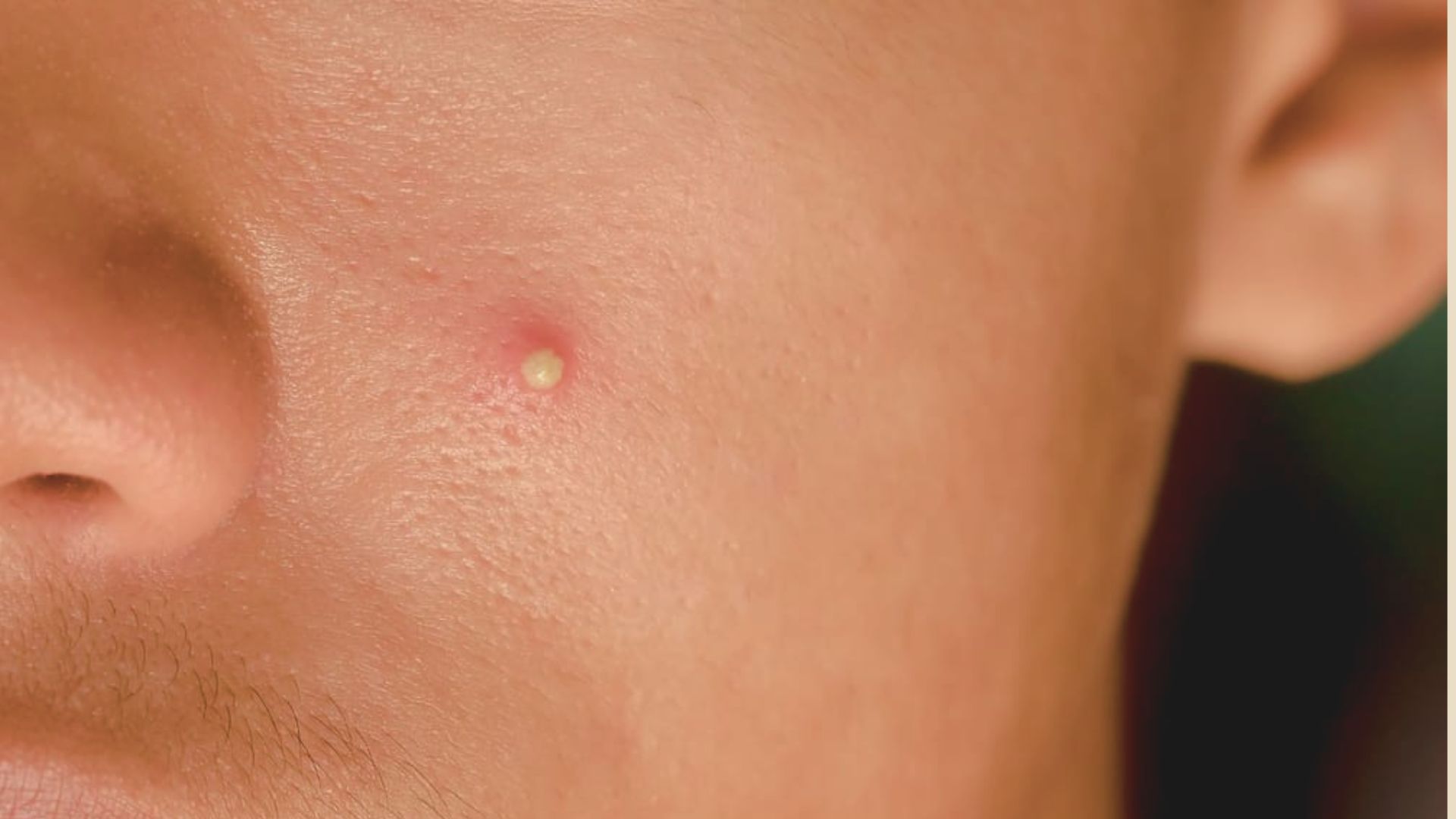 A man's face with a noticeable pimple on his cheeks.