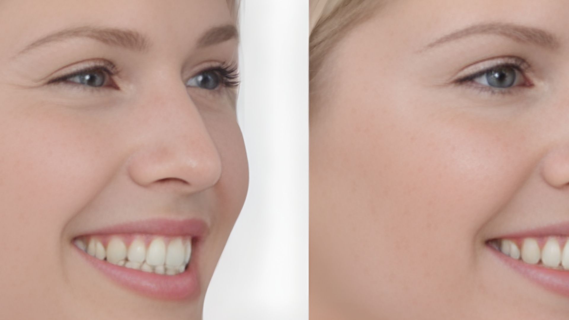 What Is Preventative Botox and How It Works?