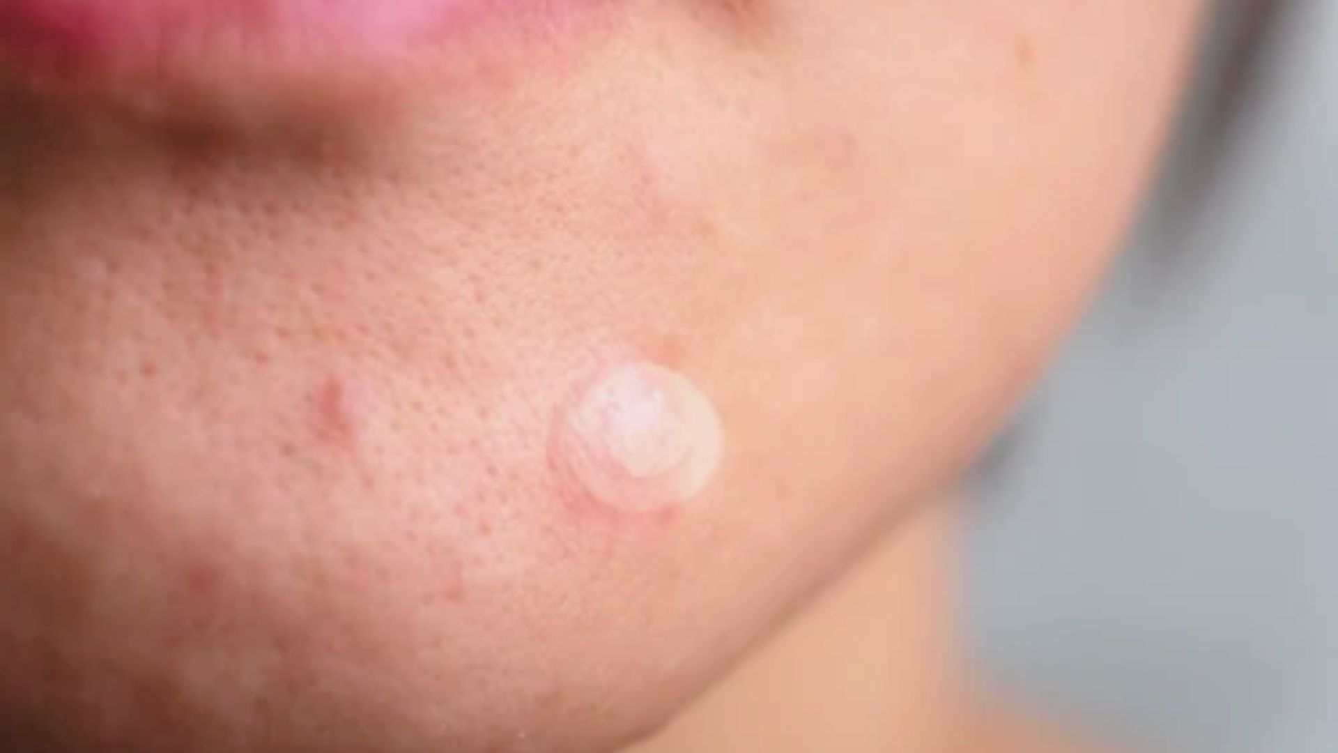 Close-up of a woman's face showing a small white pimple patch on her skin.