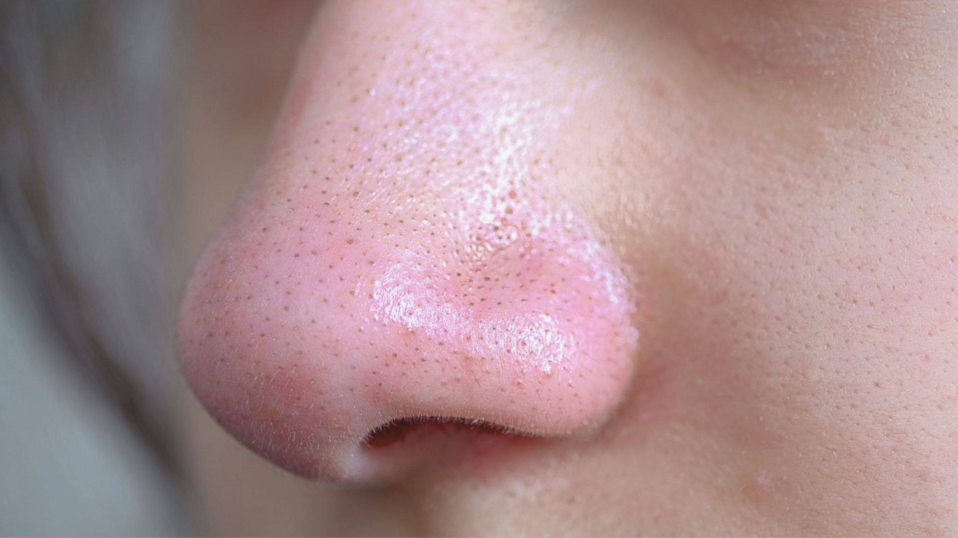 Close-up of a person's nose showing a pink spot, indicating the presence of blackheads.