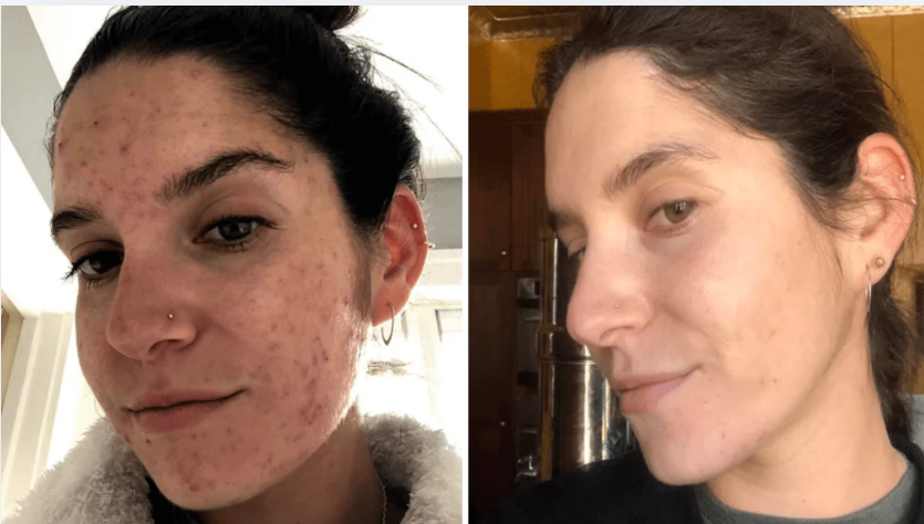 A woman with acne on her face, reflecting concerns about skin purging duration and its effects on her appearance.