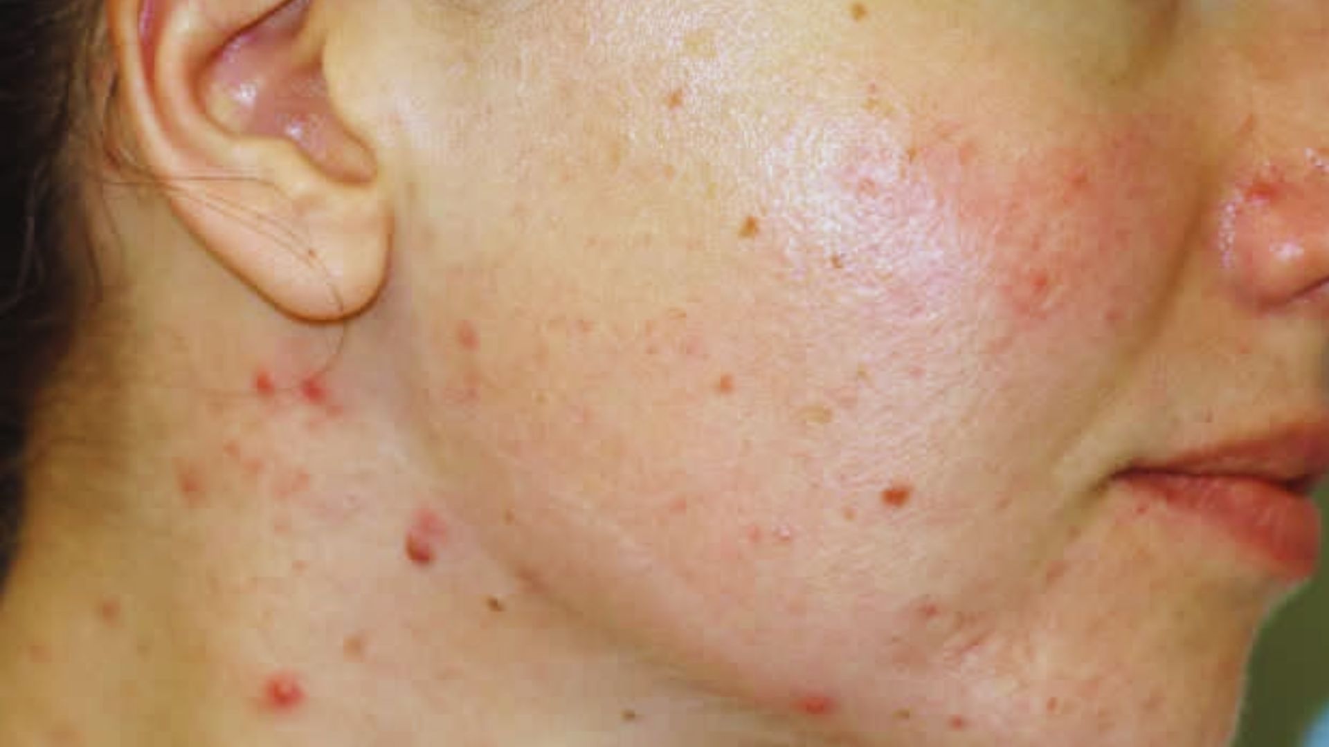 A woman's face displaying acne, highlighting the challenges of adapalene purging and methods to alleviate it.