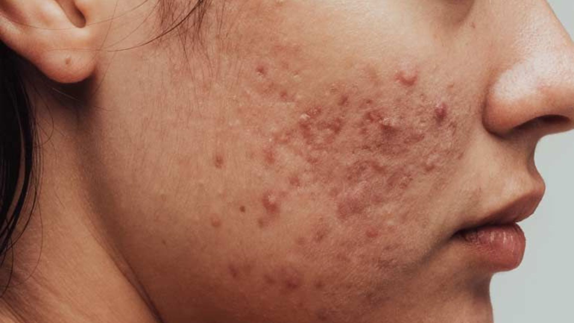 . Close-up of a woman's face showing acne on her cheeks and forehead, highlighting skin texture and imperfections.