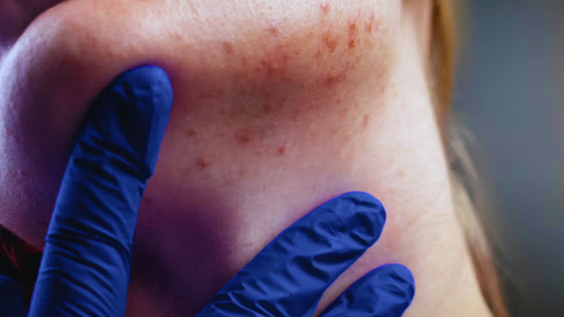A woman receives acne treatment from a doctor, who is also addressing acne on her jawline