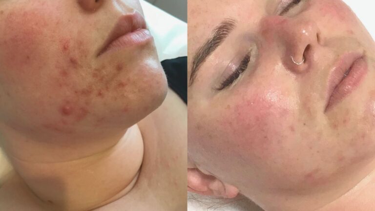 Before and after images showing the effectiveness of doxycycline in treating acne. Visible improvement in skin clarity.