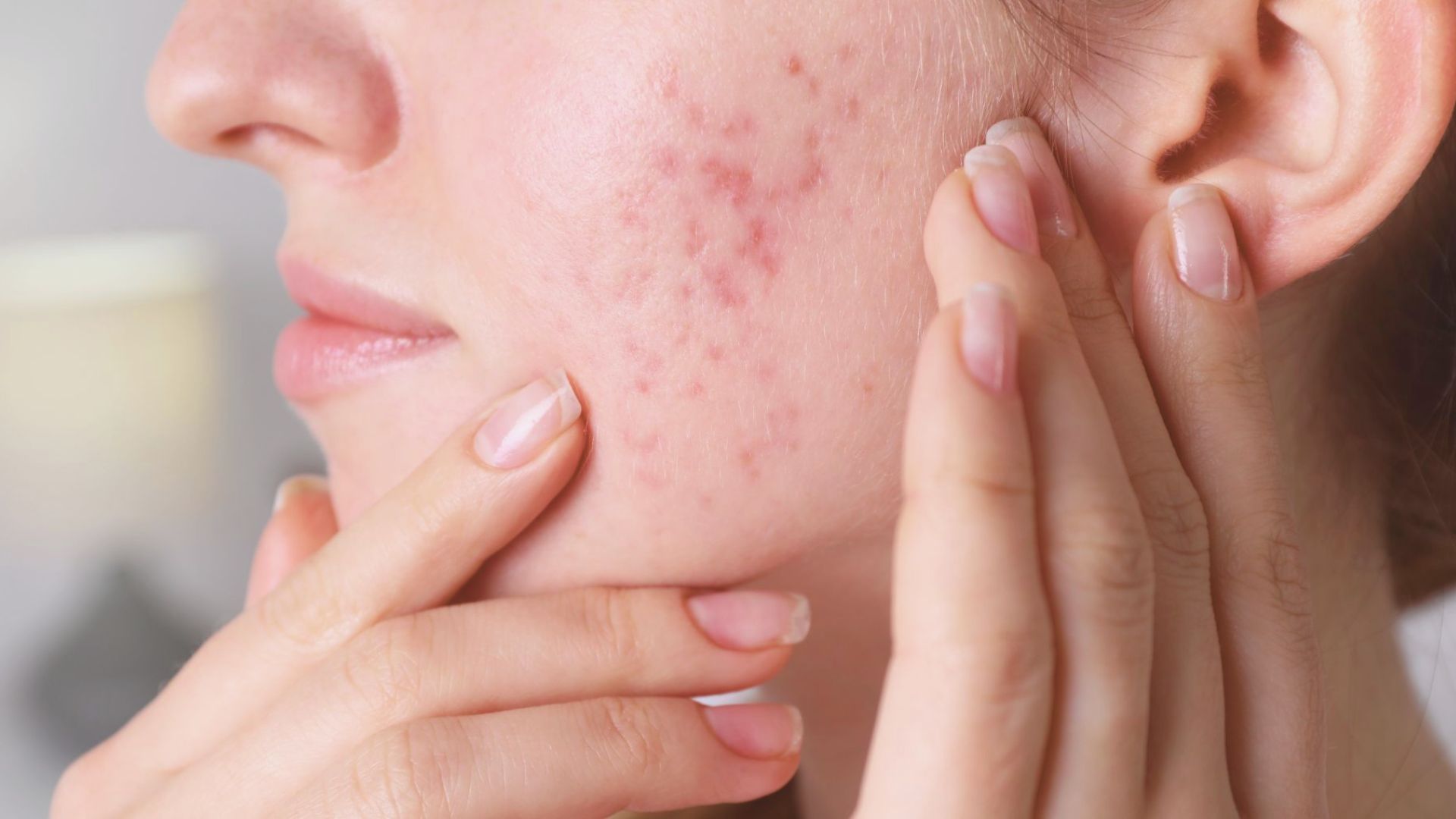 Image of acne treatment products for women, with a focus on research about eggs and their potential link to acne.