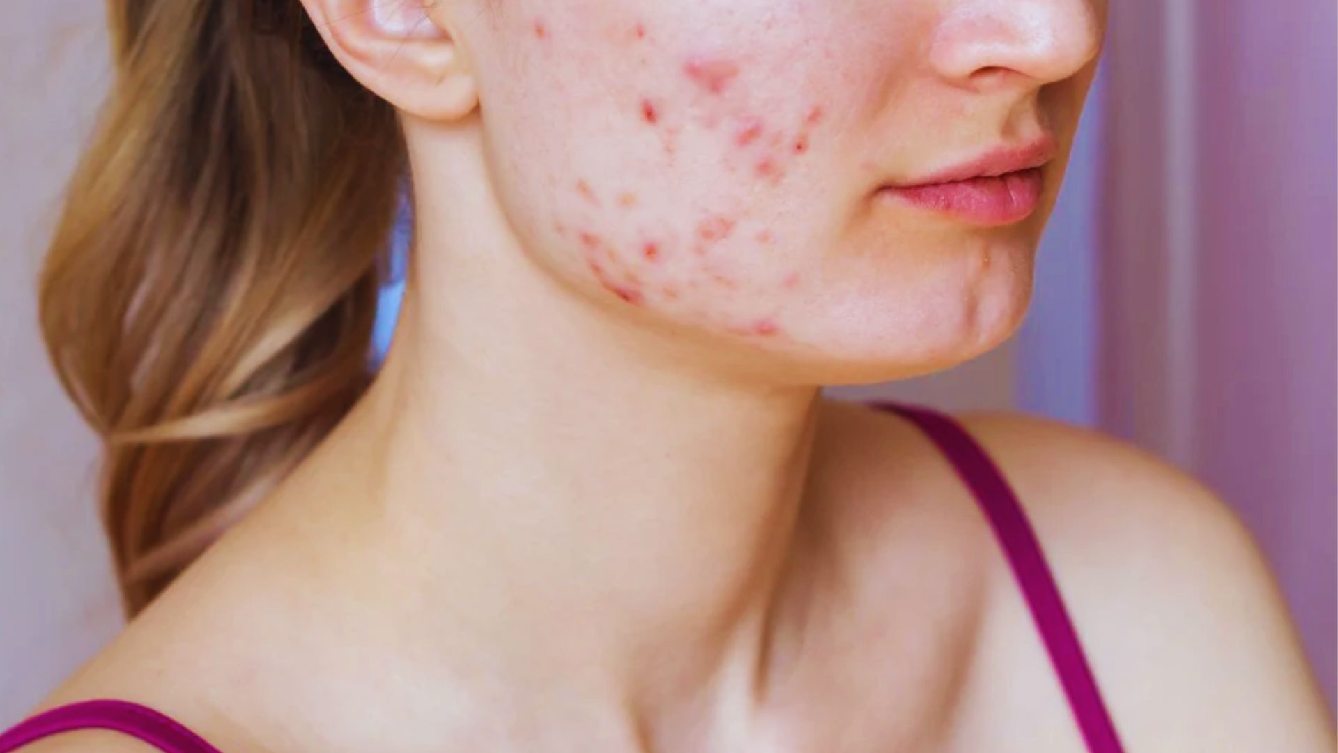 A woman with visible acne on her face, illustrating the difference between purging and breakouts.