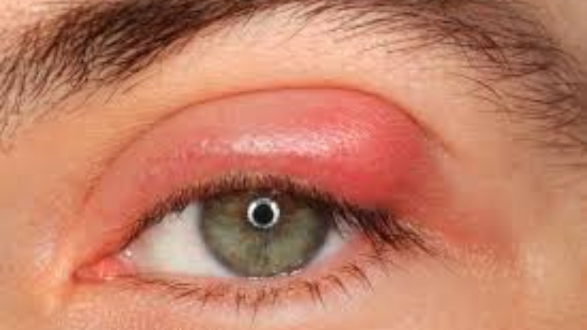 A person with red eyes and a noticeably swollen eye, indicating possible irritation or an allergic reaction.