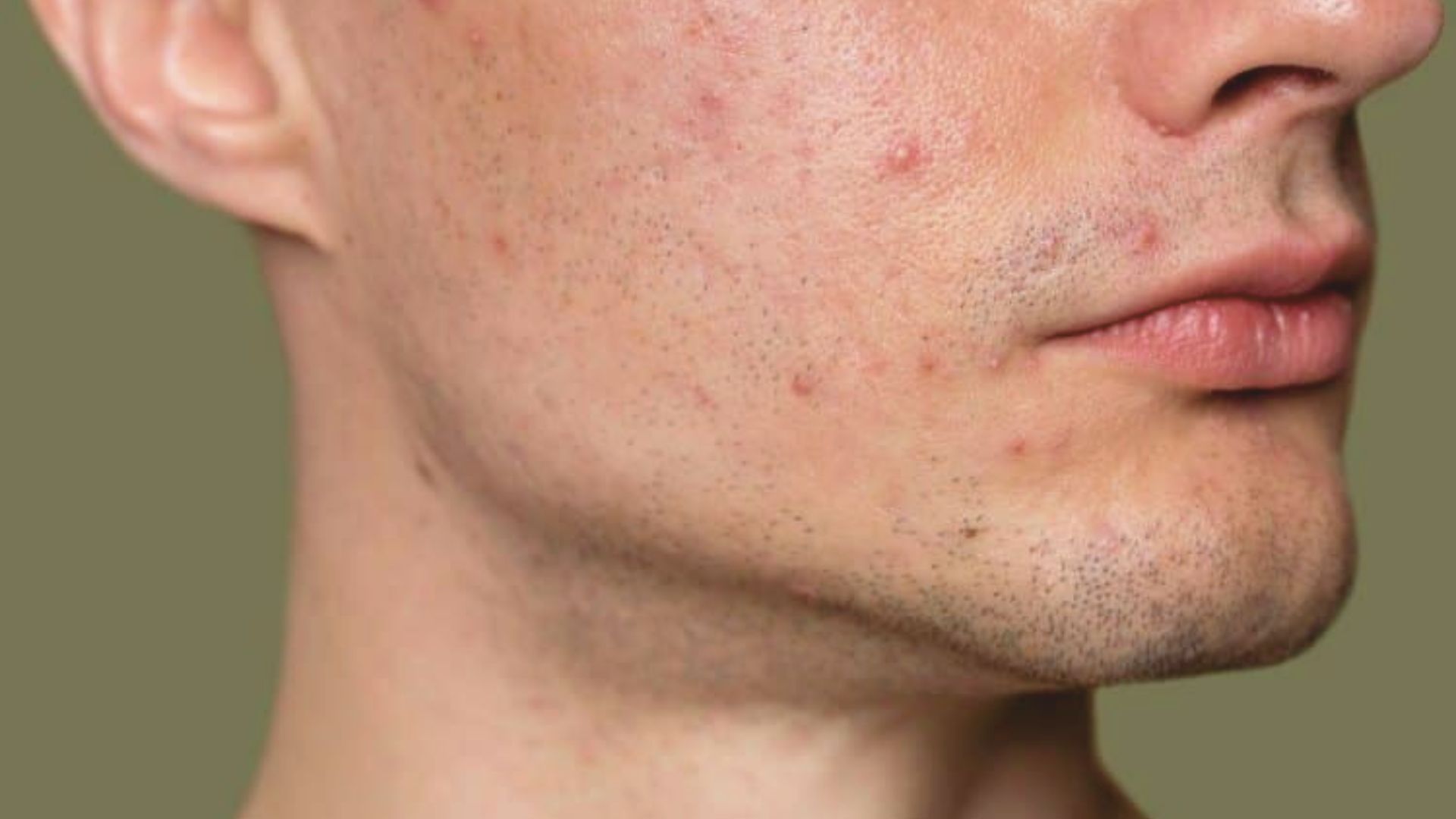 A man with acne on his face, raising questions about the potential link between creatine and acne development.