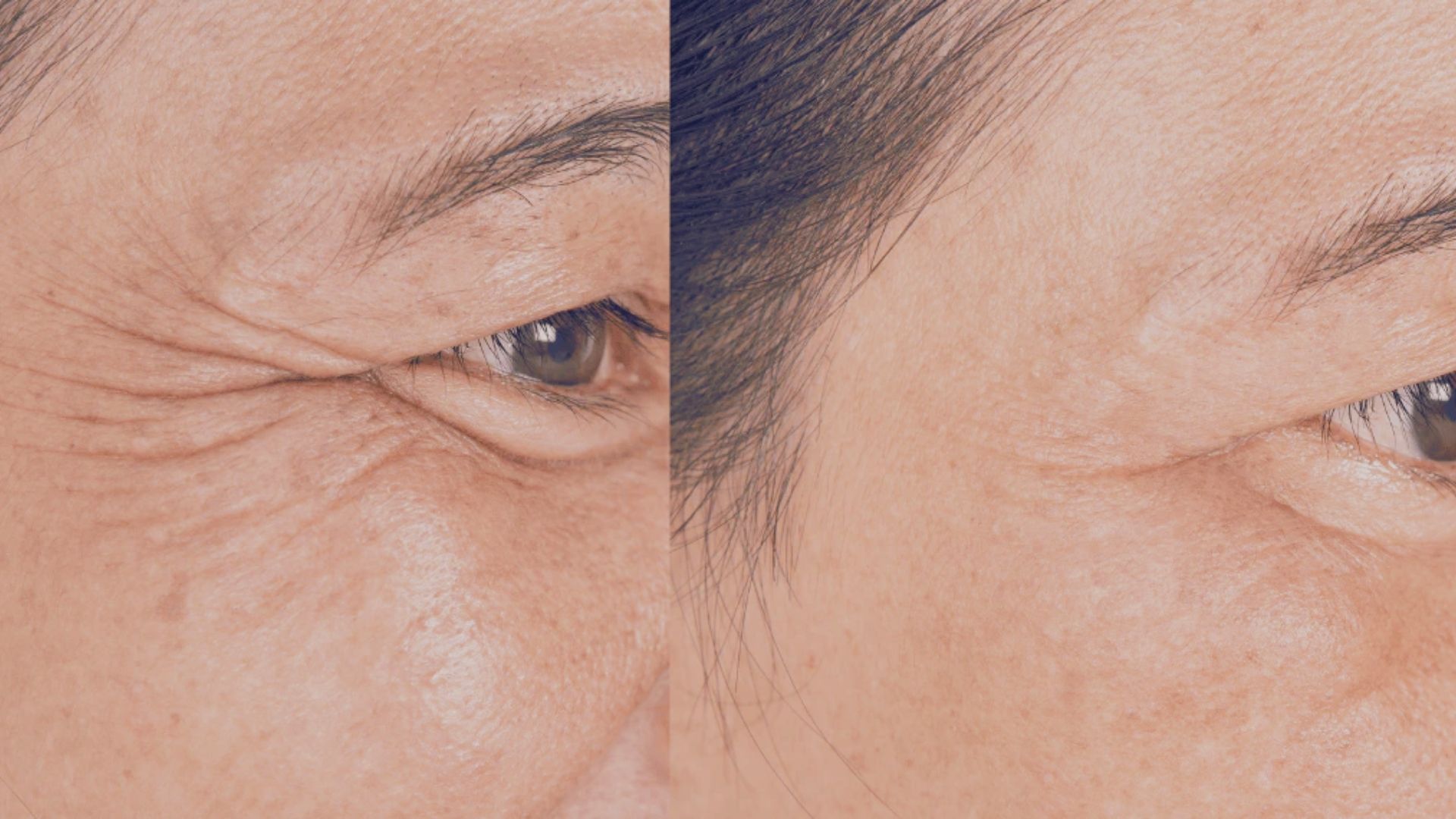 A woman’s face showing wrinkles before and after treatment, highlighting the improvement in her skin's appearance.