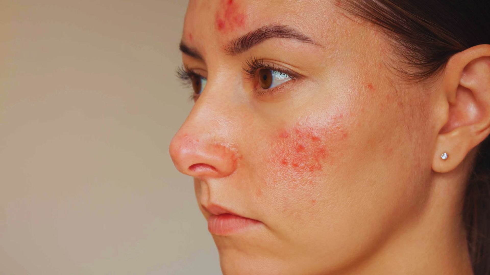 A woman with red spots on her face, looking directly at the camera with a neutral expression.