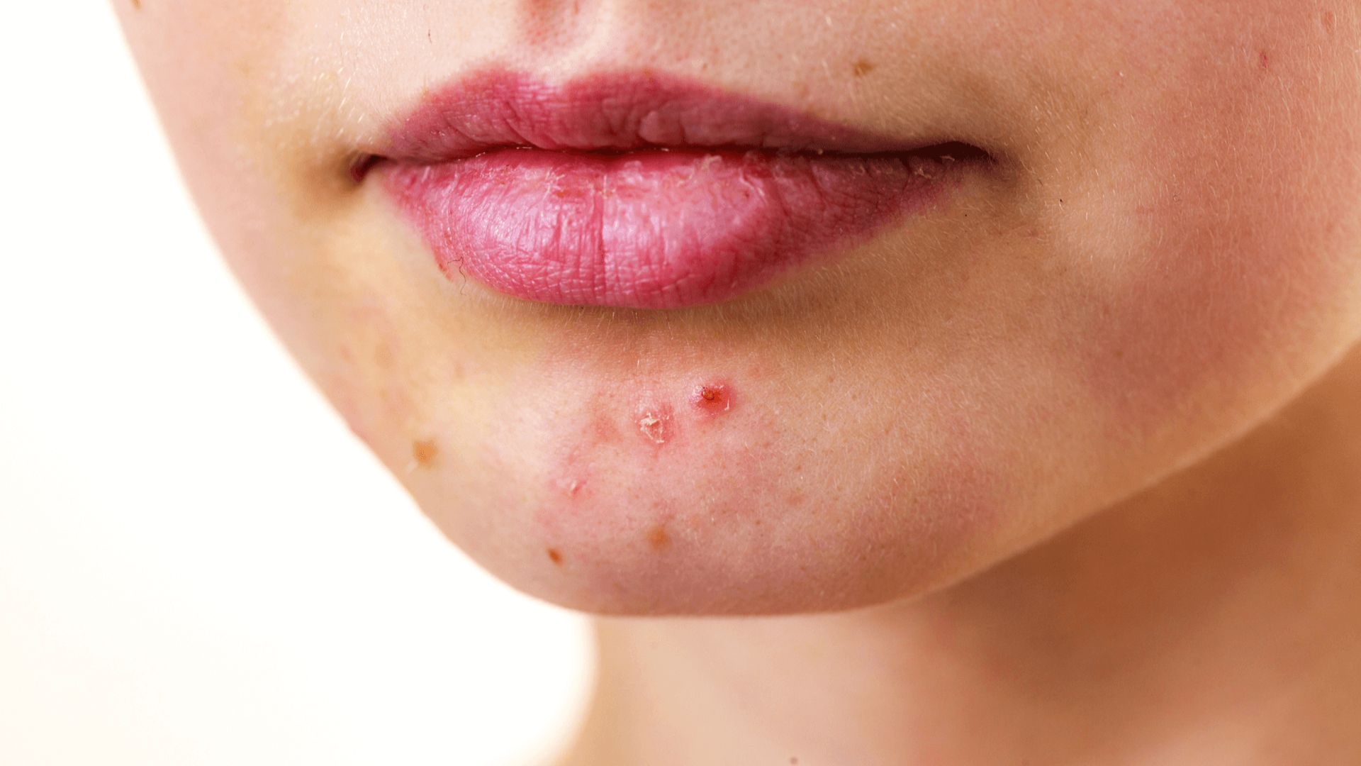 A woman with acne on her face, reflecting progress as her skin starts to calm down in weeks 6-8 of treatment.