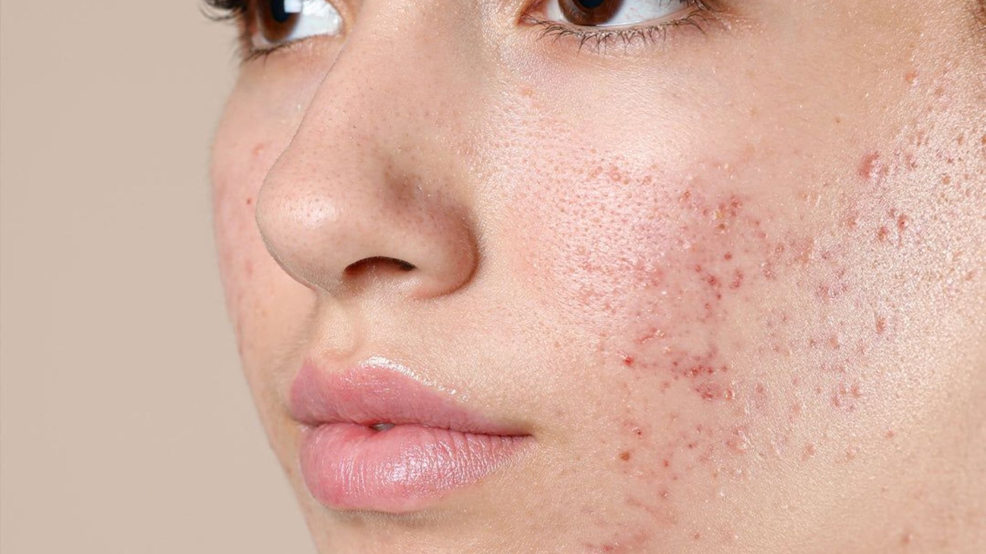 Acne treatment products specifically designed for women, featuring various skincare solutions and packaging.