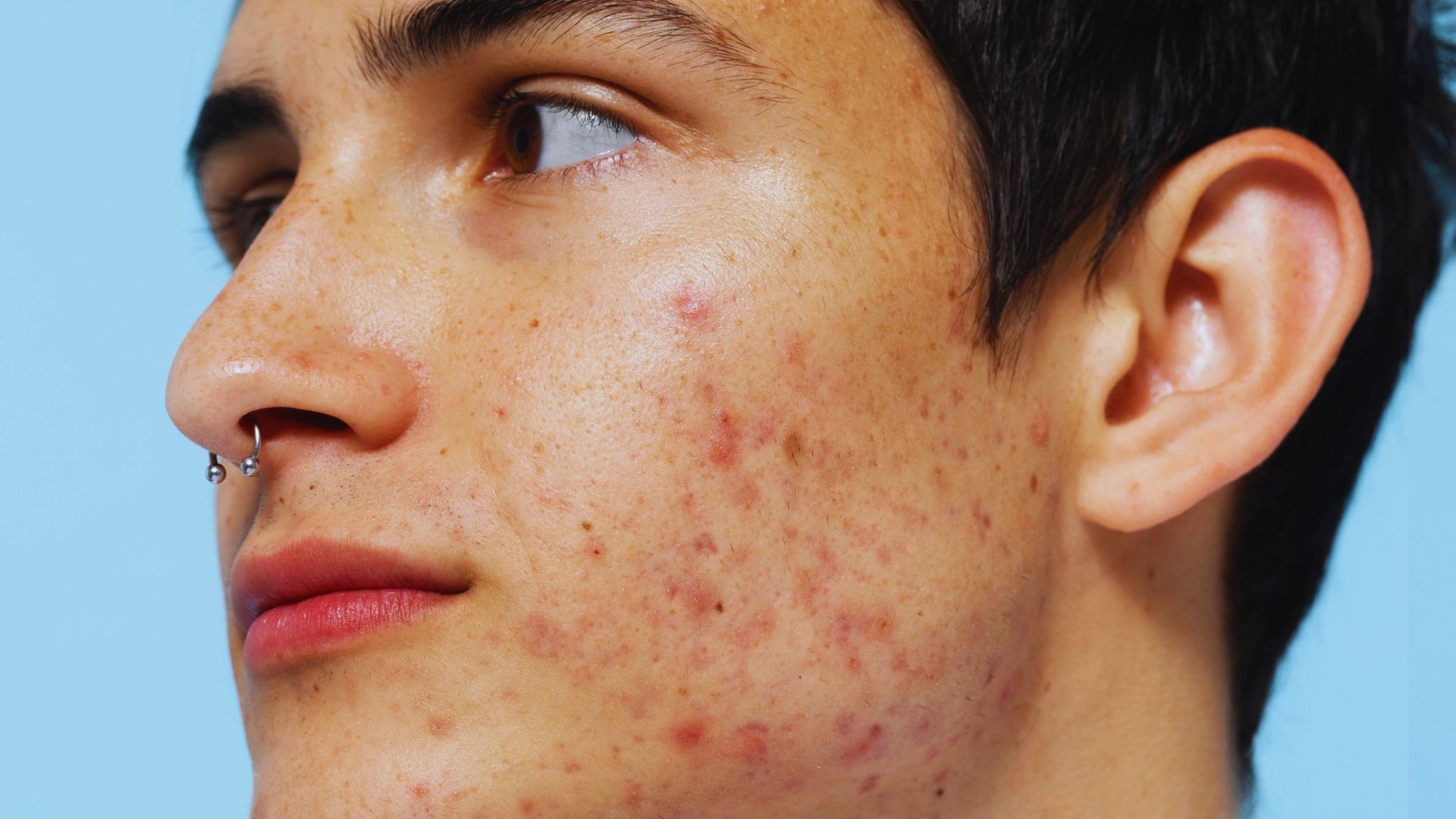 A woman with visible acne on her face, illustrating the differences between fungal and bacterial acne.