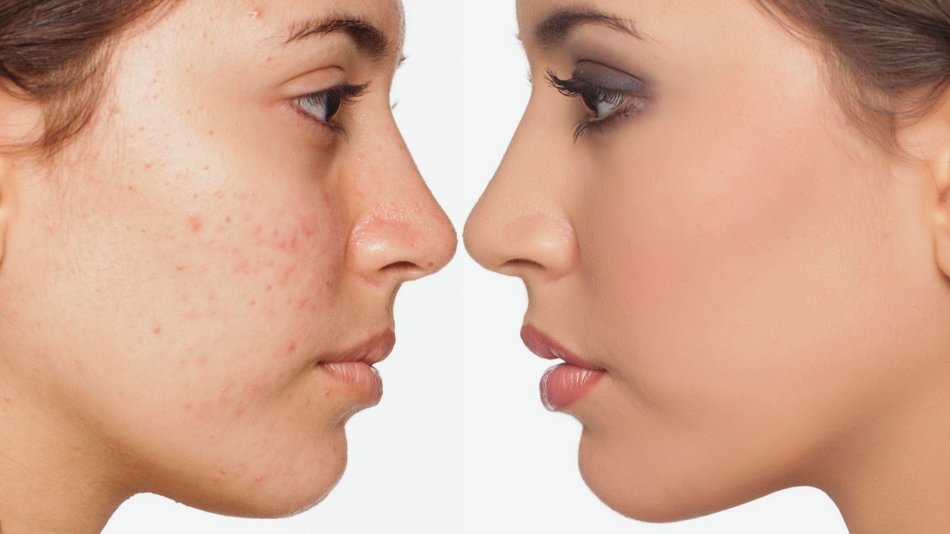 Two women side by side, one with visible acne and one with clear skin