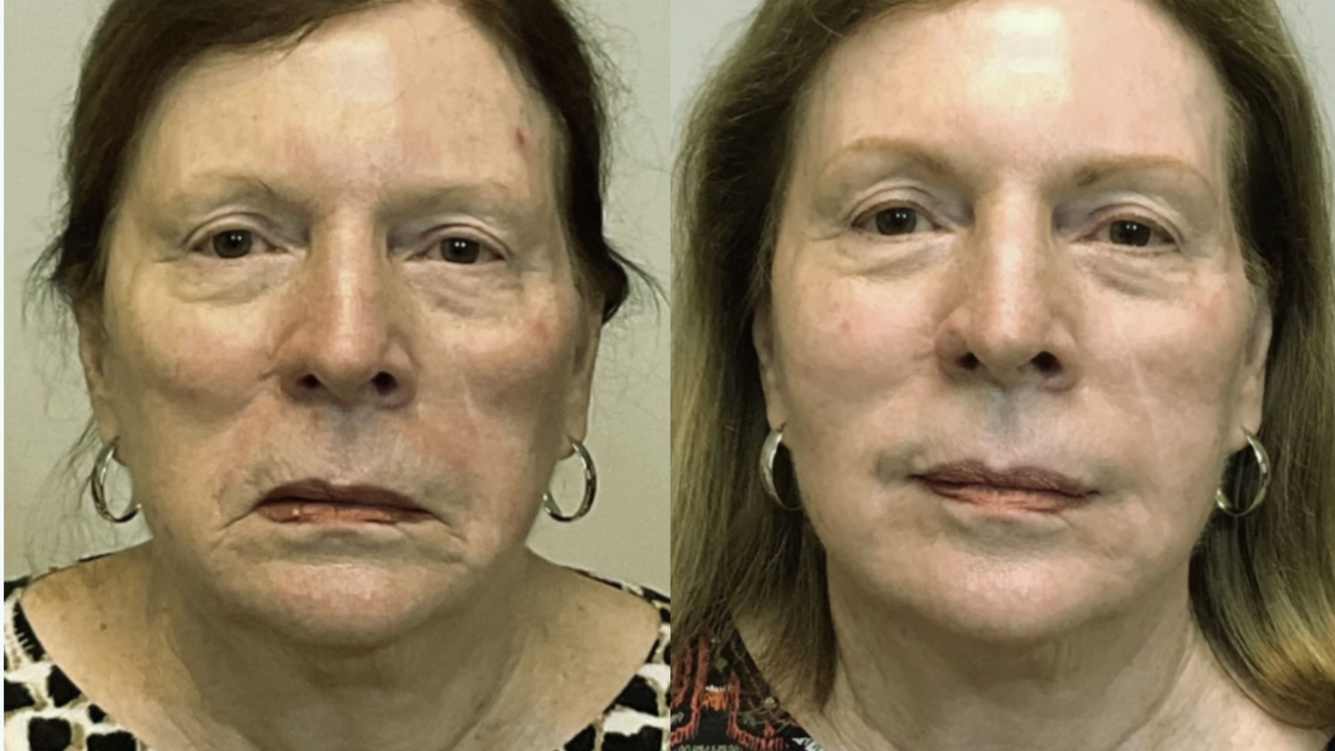 Before and after images of a woman showcasing the results of a facelift, highlighting improved facial contours and appearance.