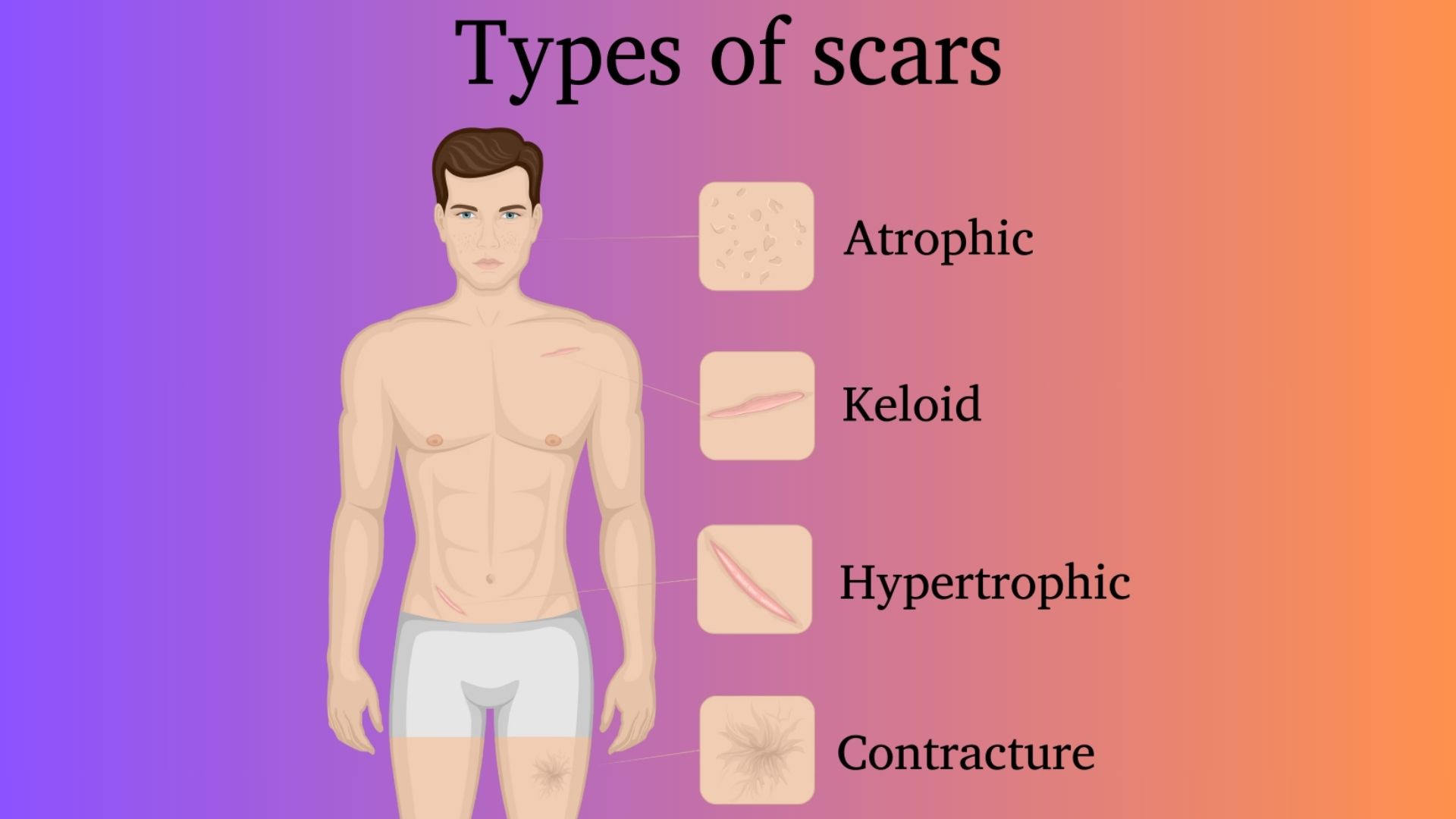 Various types of scars displayed, including keloid, hypertrophic, atrophic, and acne scars on a neutral background.