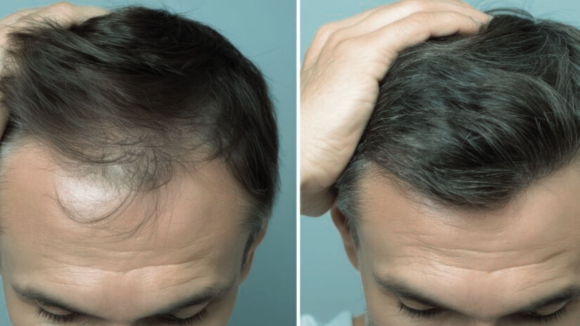 1. Hair loss treatment products for men displayed on a shelf, including shampoos and topical solutions.