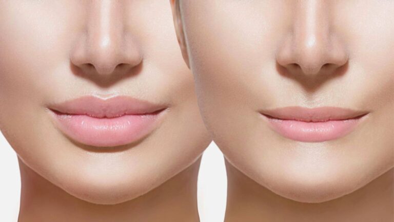 A close-up of a woman's lips showing the difference before and after receiving lip fillers.