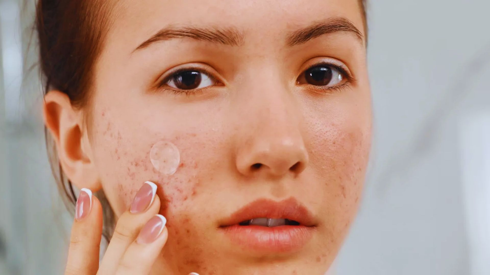 A woman with acne on her face, considering the use of pimple patches before or after applying moisturizer.