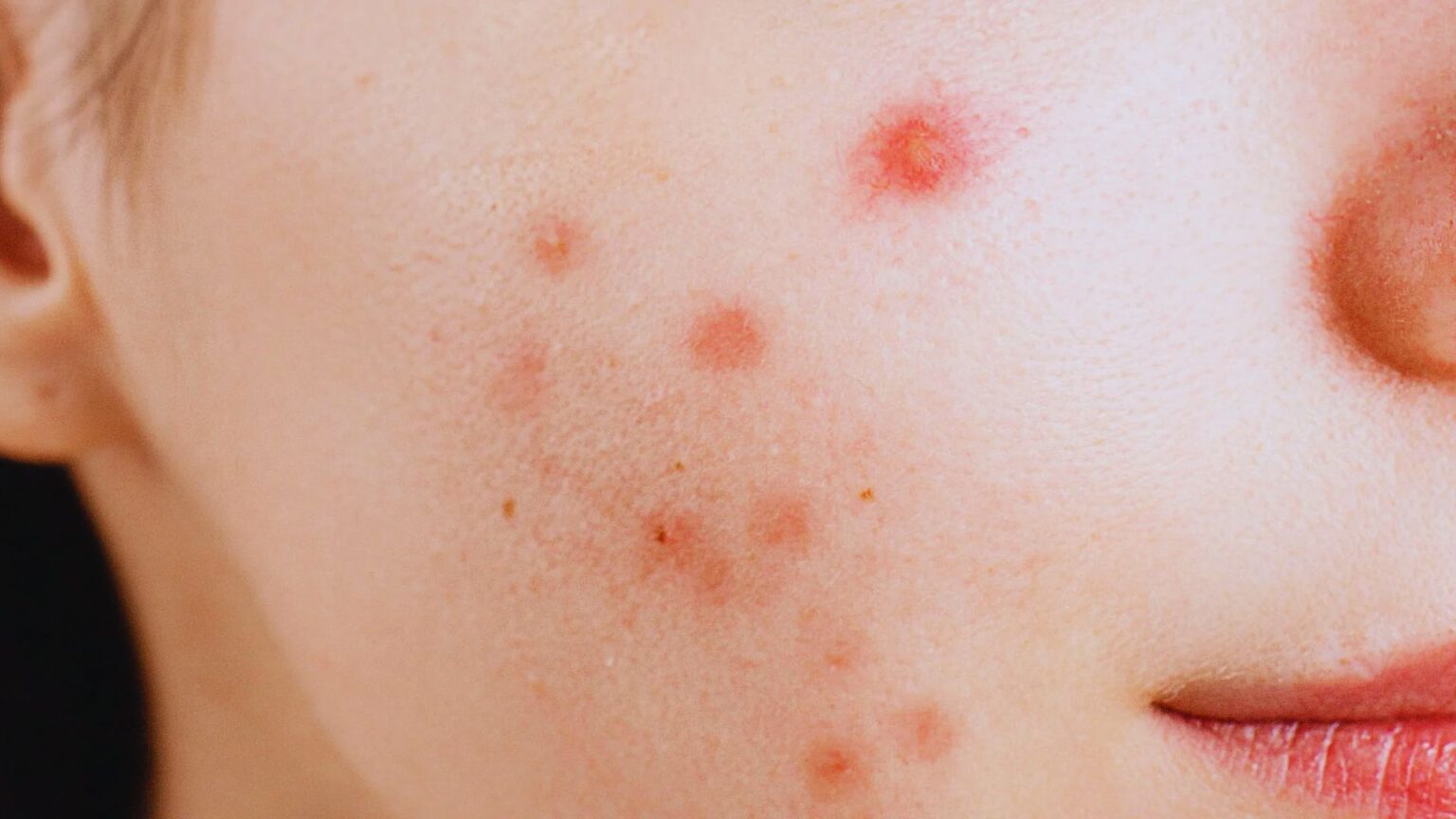 Apd Rashes Does Adapalene Cause Purging? Signs It’s Normal | TheBeautyFoodie