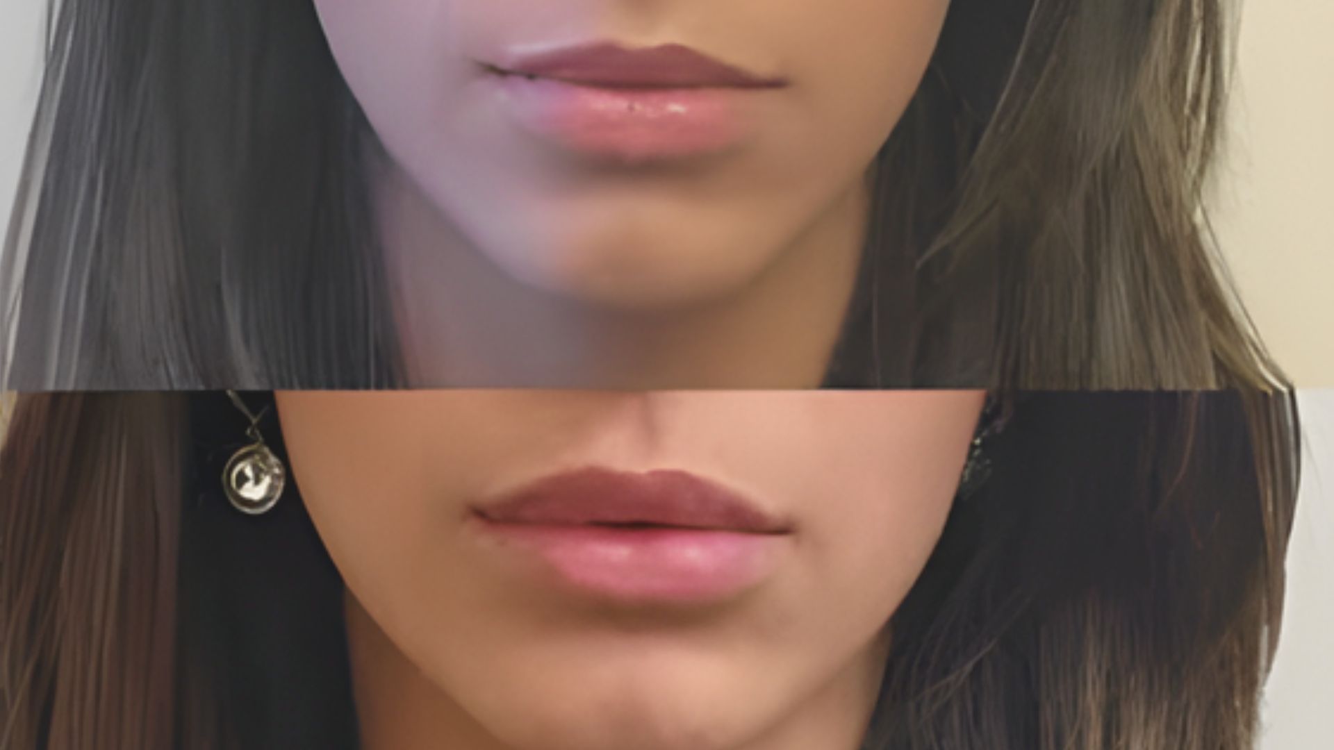 A woman's face shown before and after lip injections, highlighting the enhanced fullness and shape of her lips.
