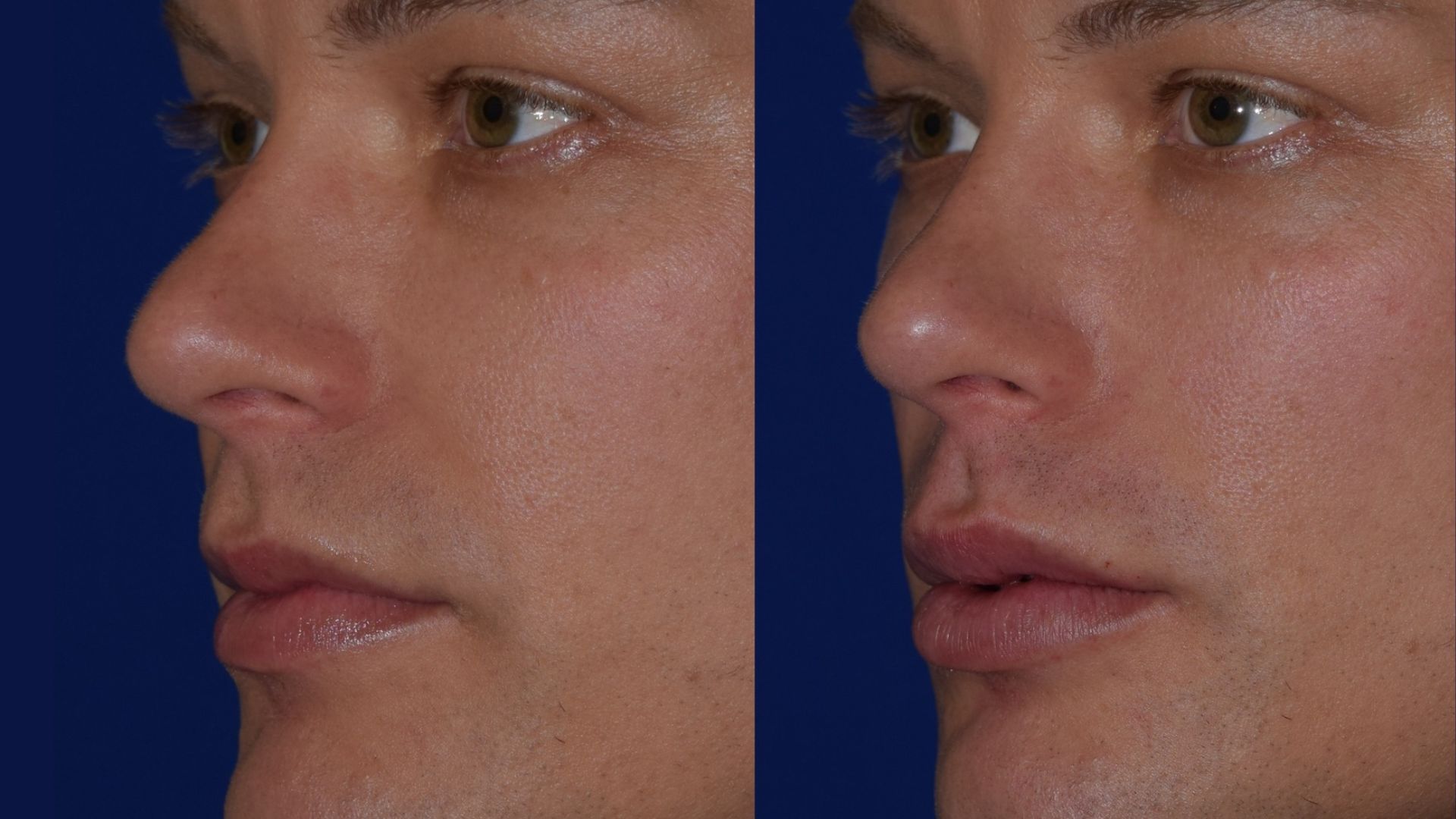 A man's face shown before and after rhinoplasty, highlighting the changes in his nose and overall facial profile.