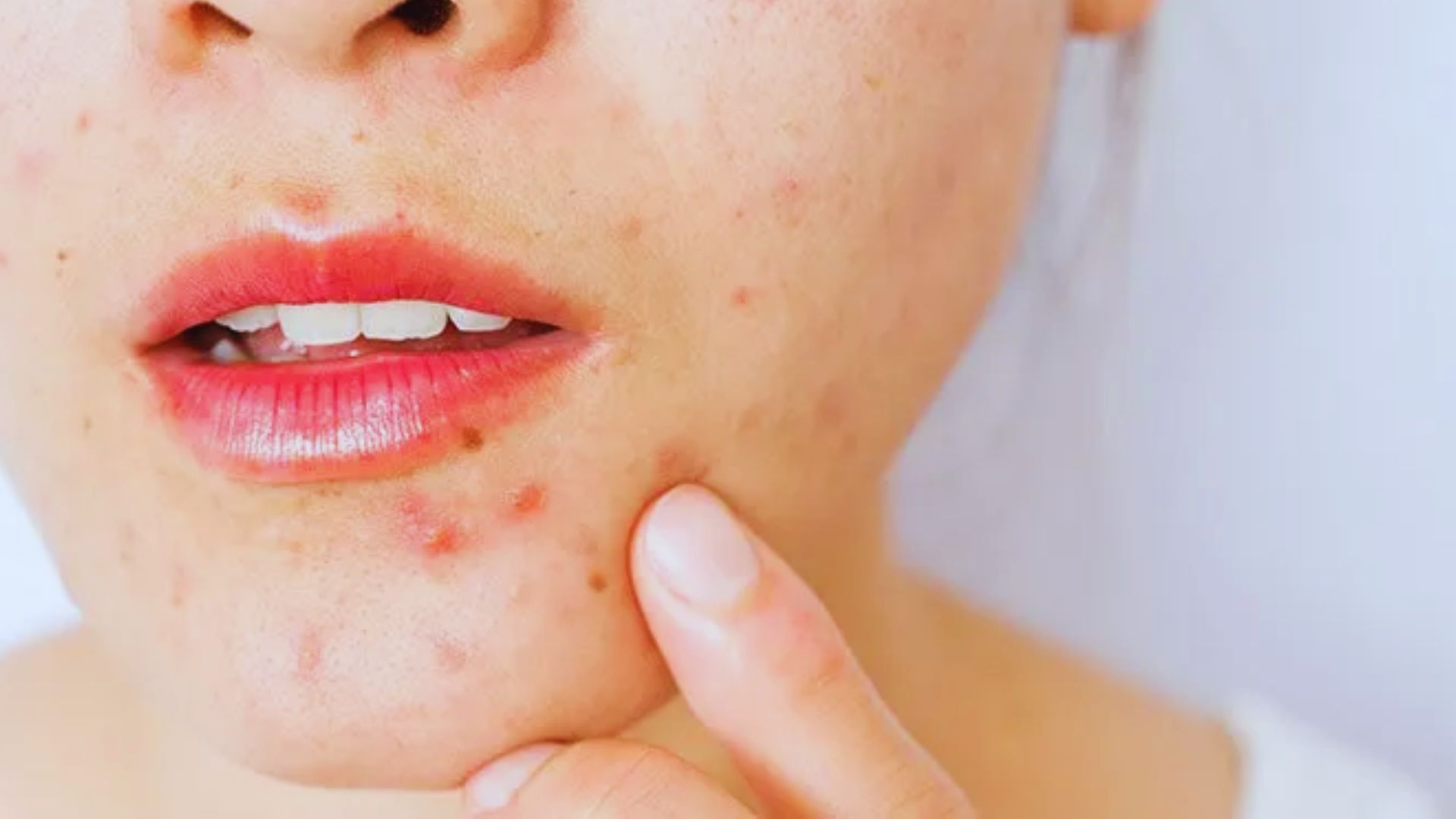 A woman with visible acne on her face, showcasing her natural skin texture and features.