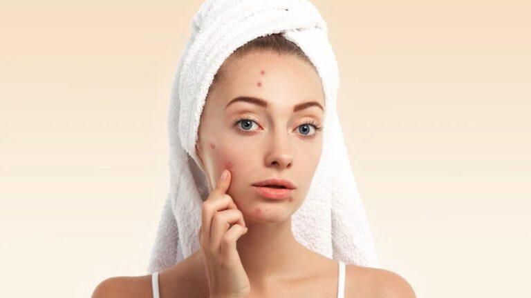 A woman with visible acne on her face, showcasing a range of skin textures and tones.