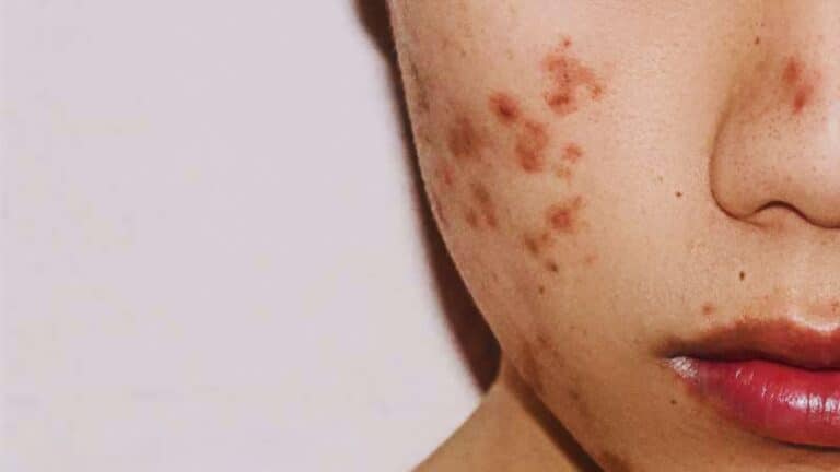 15 Types of Skin Blemishes and How to Identify Them | TheBeautyFoodie