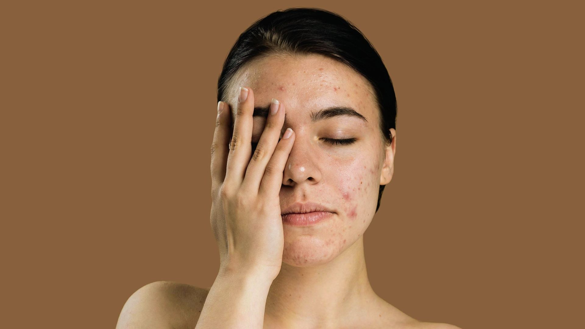A woman with visible acne on her face, showcasing a range of skin textures and tones.