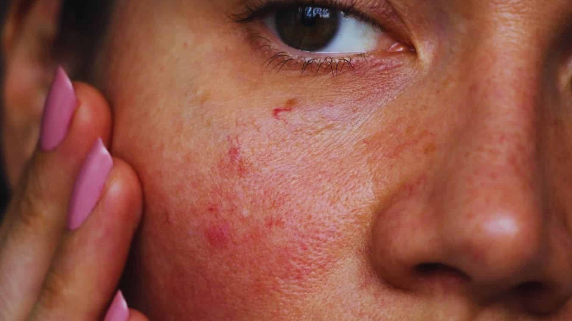 A woman with visible acne on her face, showcasing a range of skin textures and tones.