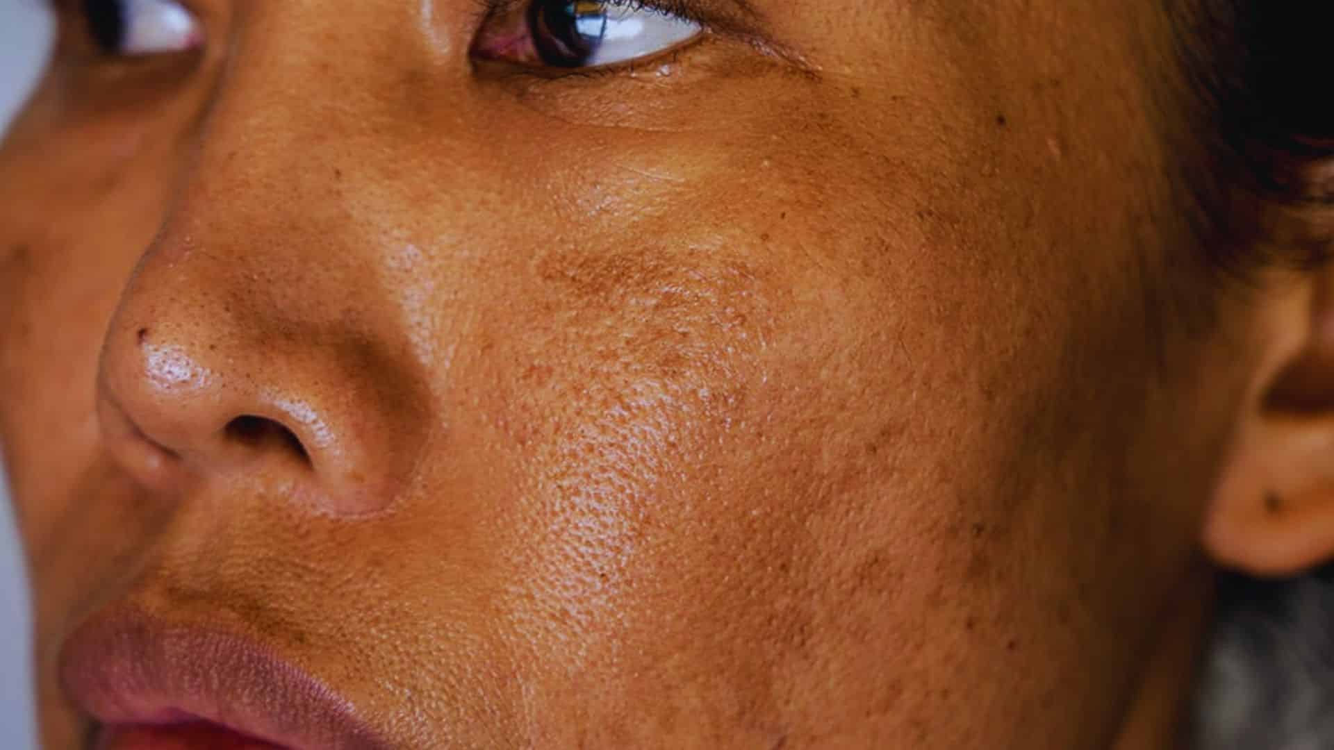A detailed view of a woman's face highlighting her freckles and expressive features.