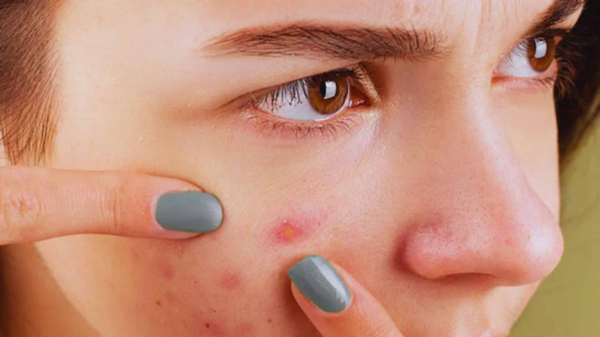 A woman with visible acne on her face, showcasing a range of skin textures and tones.