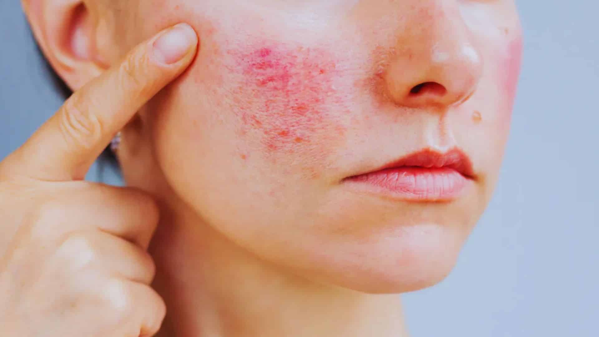 A woman with red skin on her face, displaying a unique skin condition or artistic makeup