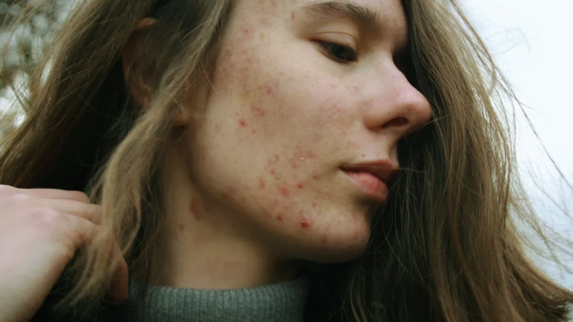 A woman with visible acne on her face, showcasing a range of skin textures and tones.