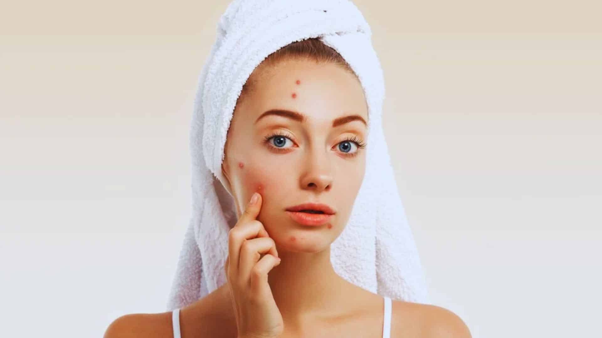 A woman with visible acne on her face, showcasing a range of skin textures and tones.