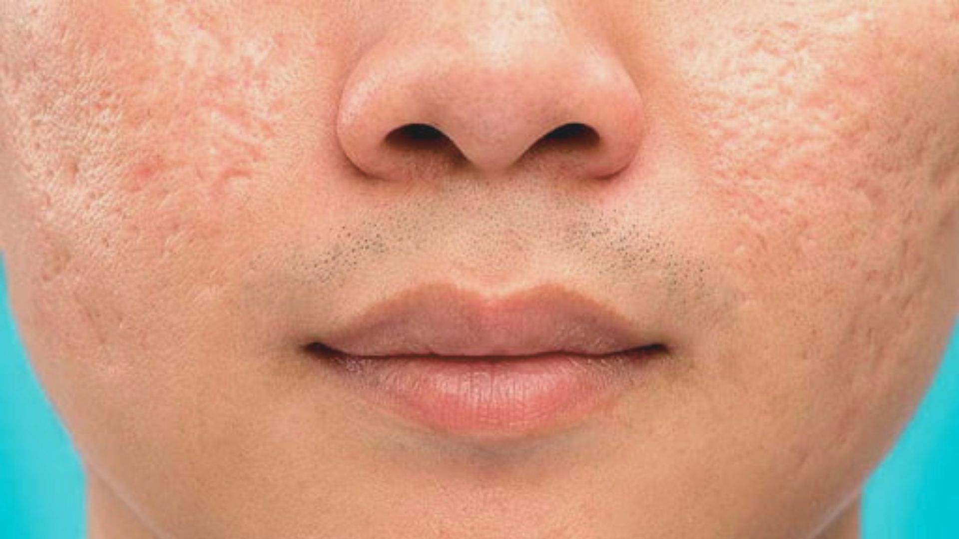 Close-up of a young man's face showing acne on his cheeks and forehead.