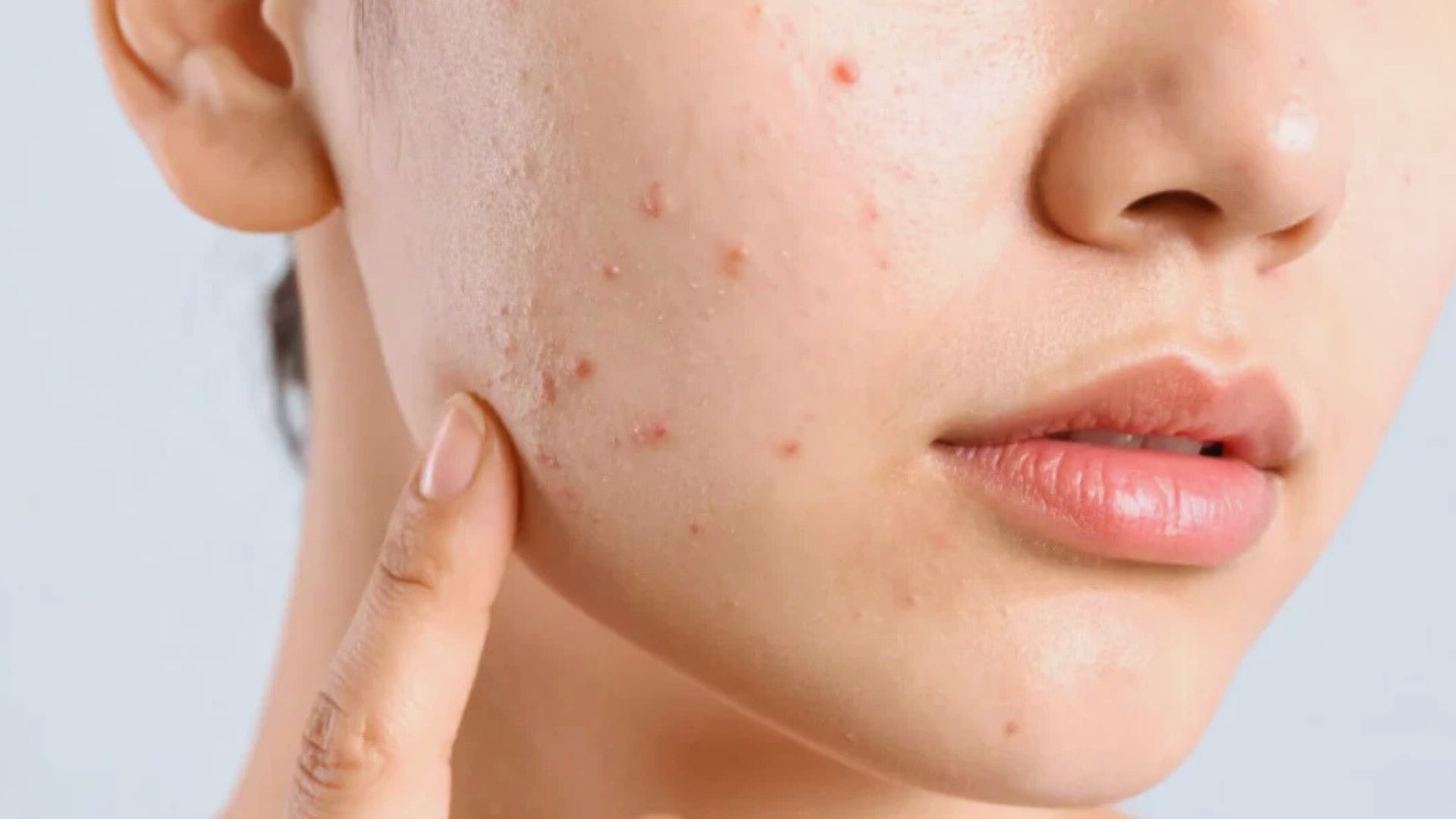 A woman with visible acne on her face, showcasing a range of skin textures and tones.