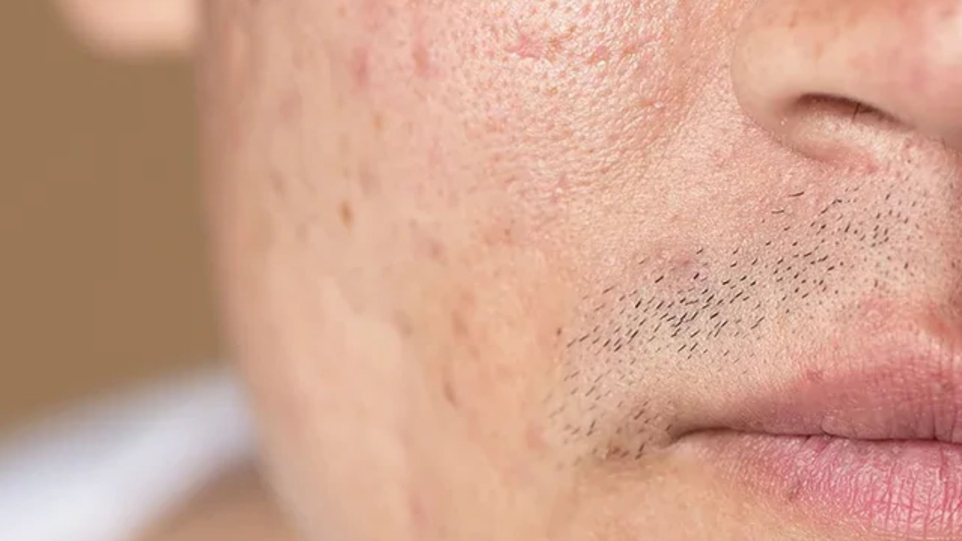 Close-up of a man's face highlighting a small mole on his chin.