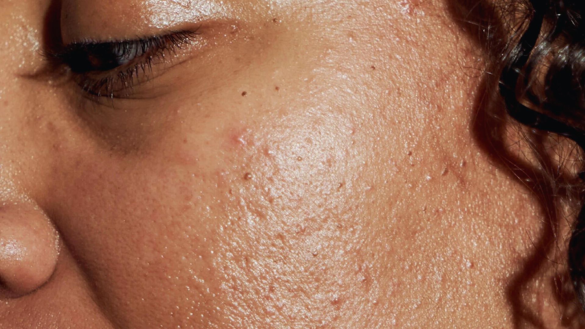 Close-up of a woman's face showing acne, highlighting skin texture and imperfections.
