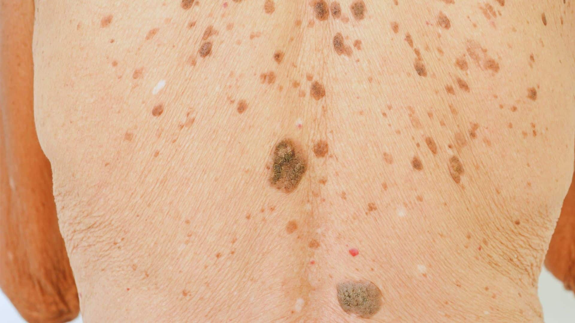 A man showing his back covered in numerous spots, highlighting a unique skin condition or pattern.