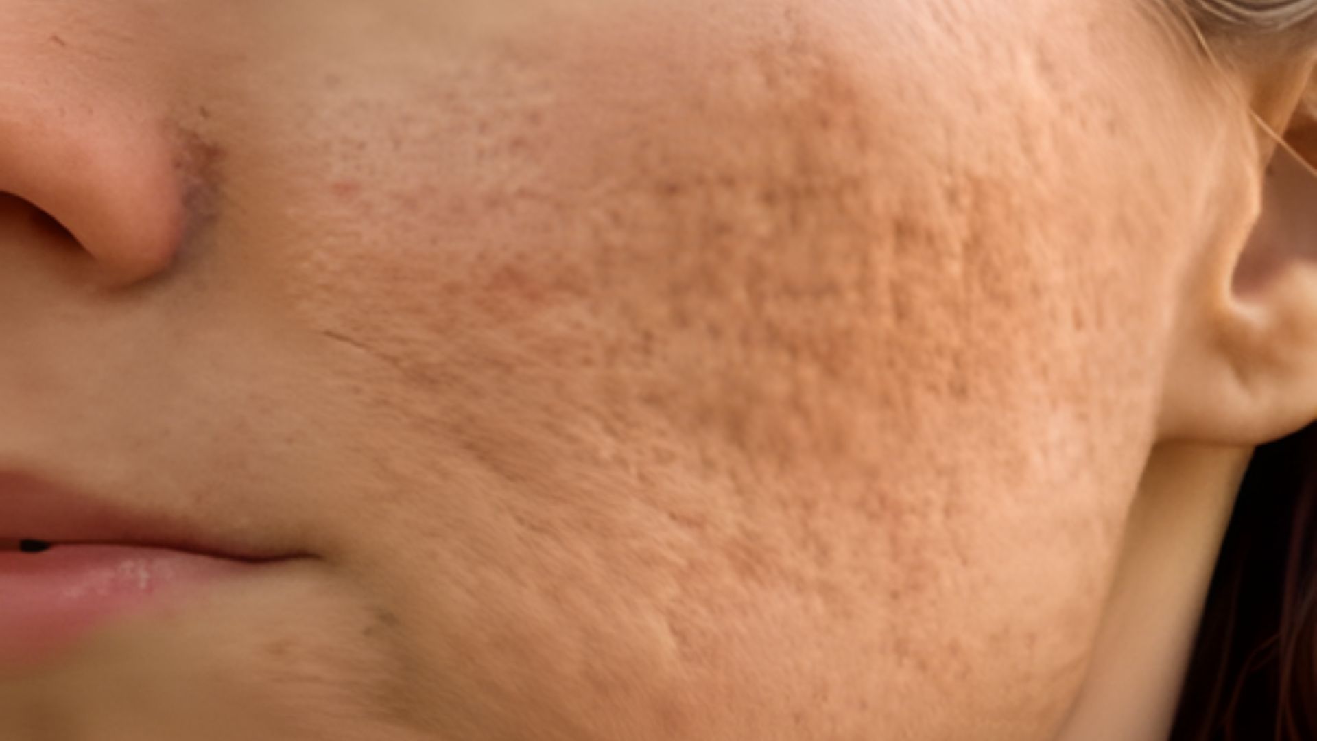 Close-up of a woman's face showing acne, highlighting skin texture and imperfections.
