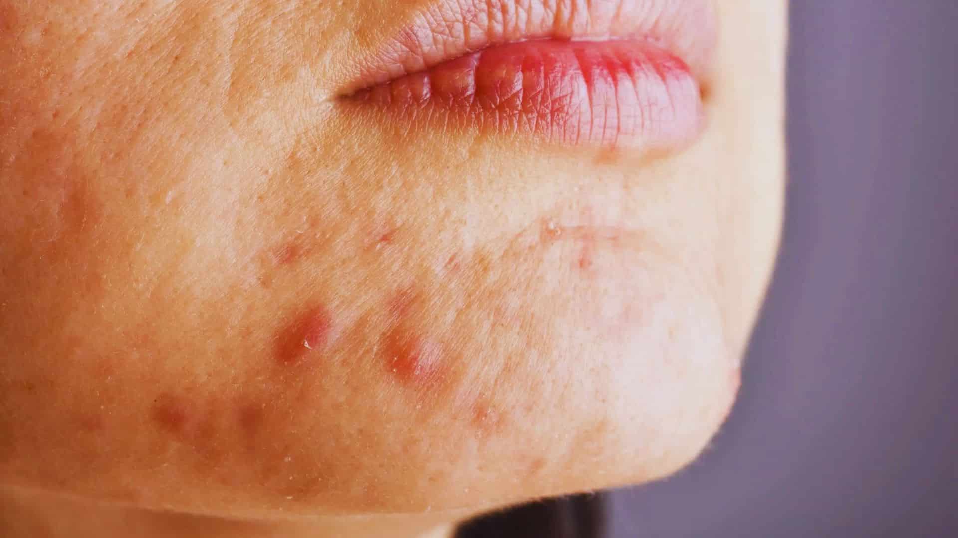 Close-up of a face showing various acne spots and blemishes on the skin, highlighting the condition's impact on appearance.