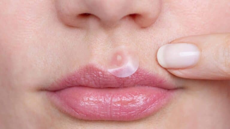 Image of a question about whether pimple patches leave scars, with a focus on skin health and acne treatment.