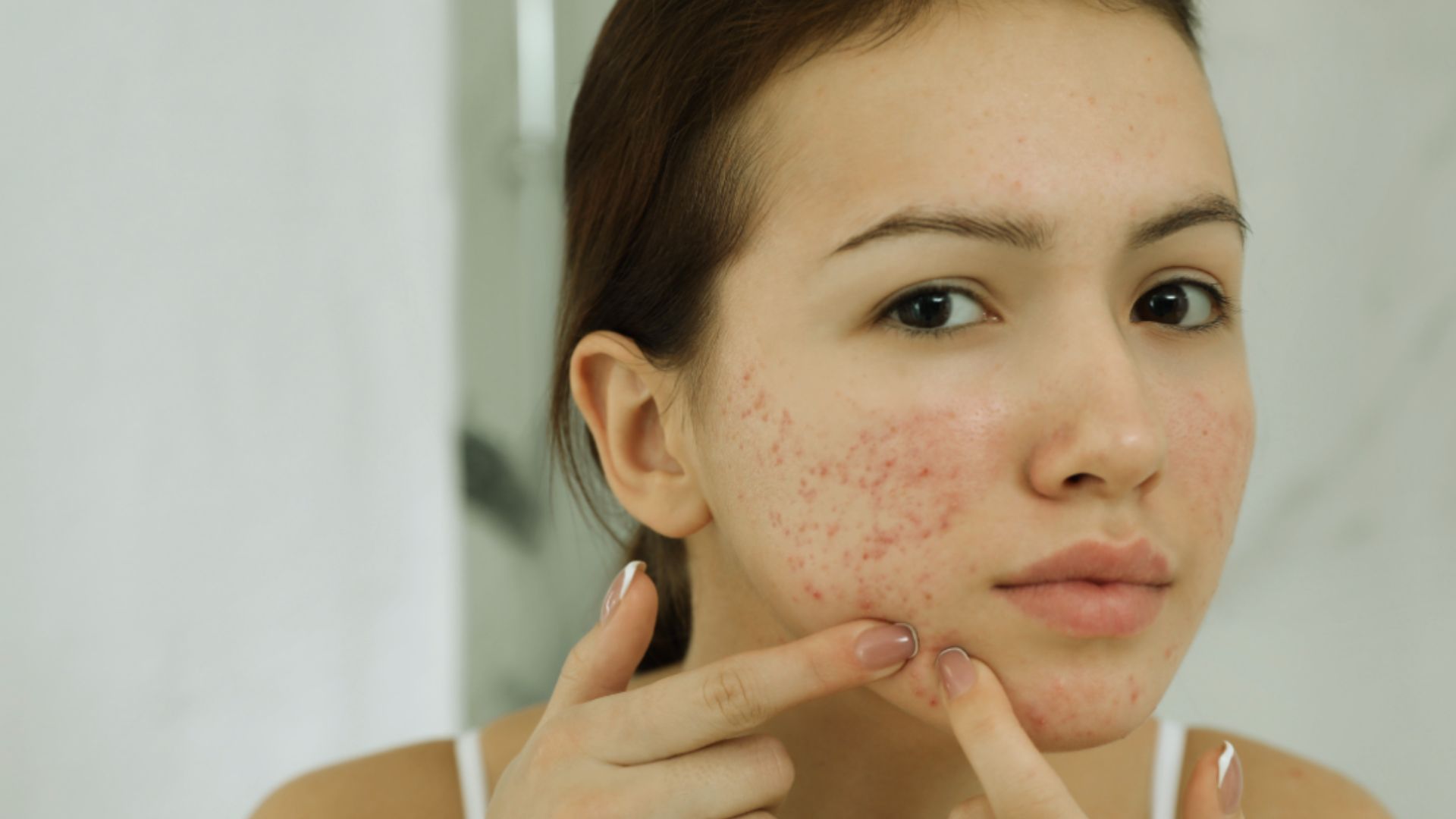 A woman with visible acne on her face, showcasing a range of skin textures and tones.
