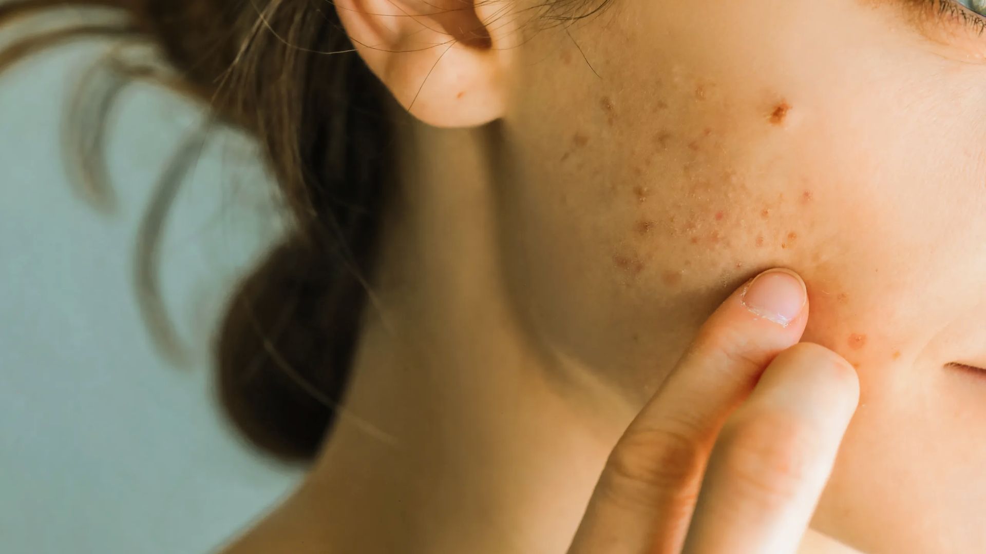A woman with visible acne on her face, showcasing her natural skin texture and features.
